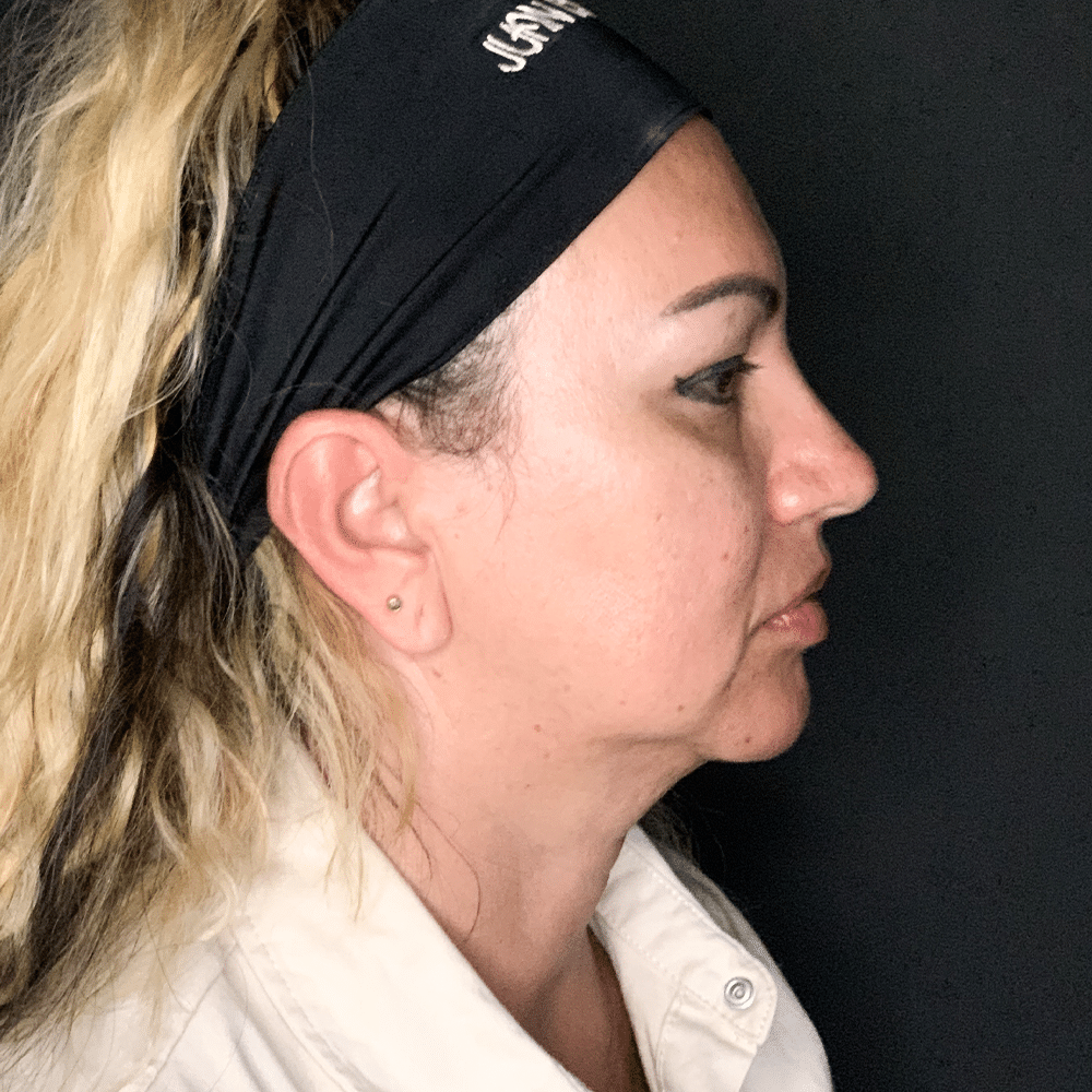 Estado antes de un lifting facial realizado por el Dr. Juan Canencio, cirujano plástico
